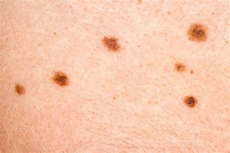 Why Does Hair Grow Out Of Moles? Surprising Answers Inside | The ...