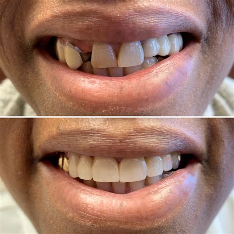 Dental Bridge Before And After