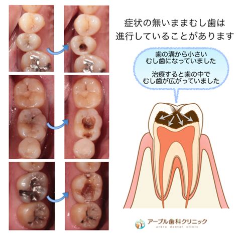 虫歯を診断するには知識と経験が必要です | アーブル歯科クリニック