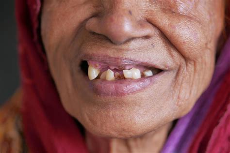 broken teeth stock  images  backgrounds