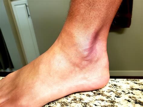 Free clip bruised ankles, Download Free clip bruised ankles png images ...