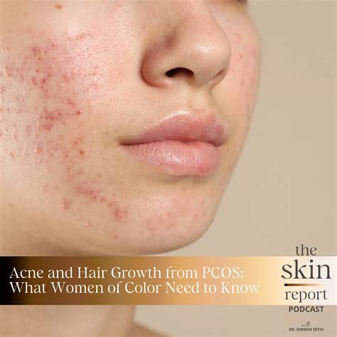 pcos chin hair 10