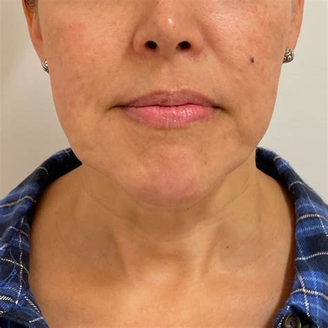 Kybella Double-Chin Treatment in Redondo Beach, CA — Beauty Cult