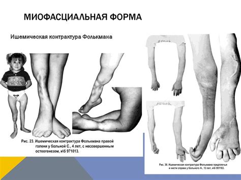 Компартмент-синдром - презентация онлайн