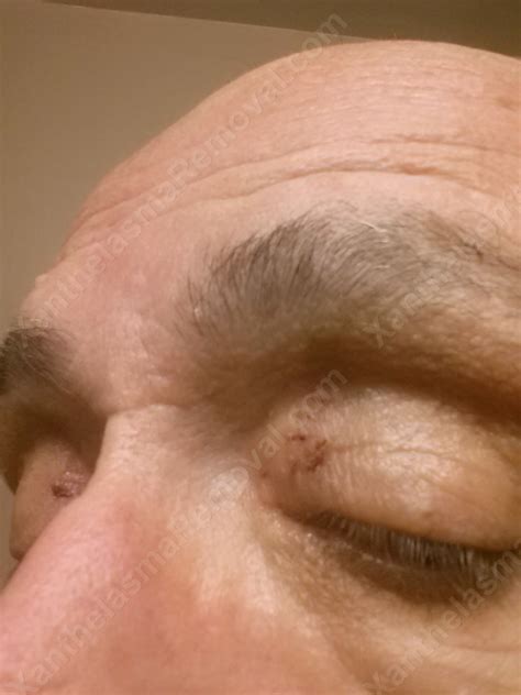 20131227_203610 | Xanthelasma Removal