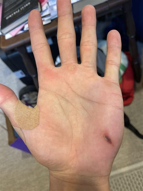 Anybody else get blood blisters on the lower part of the palm (from i