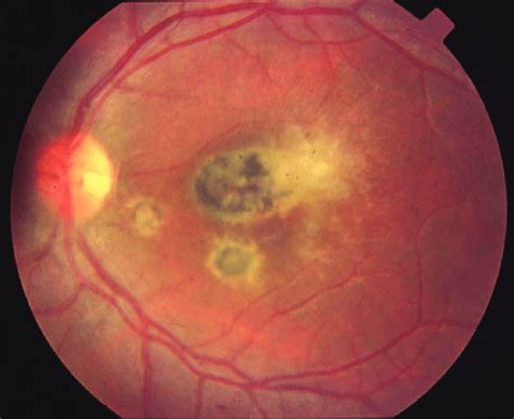 What Is Chorioretinitis? | OBN