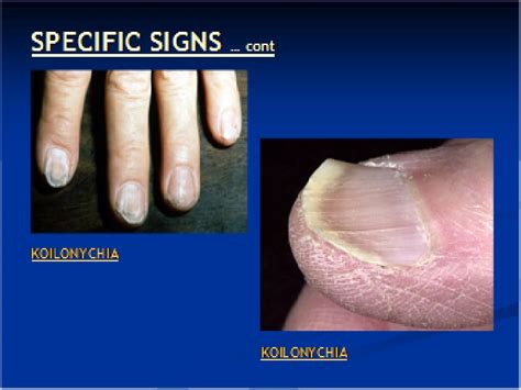 Iron Deficiency Anemia Nails