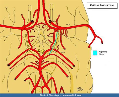 Third nerve palsy | MedLink Neurology