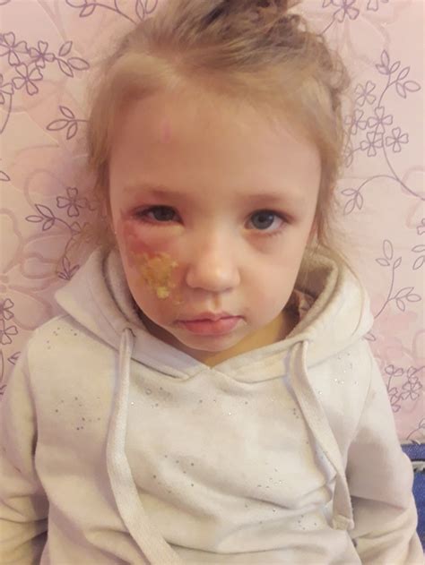 Ожог — 99 ответов | форум Babyblog