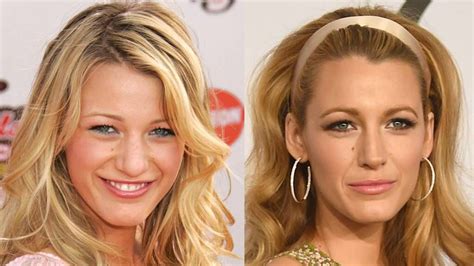 Blake Lively Before and After Nose Job Plastic Surgery - Check Out Her ...