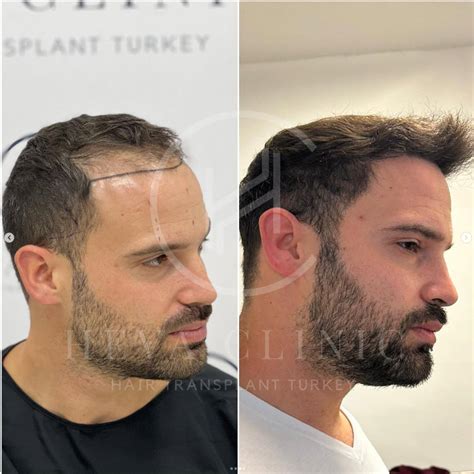 No Shave Hair Transplant - Partially & Completely Unshaven Costs 2024
