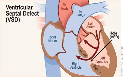 Ventricular Septal Defect (VSD) | Dayton Children's Hospital