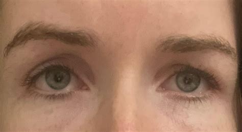 Asymmetrical eyelids : r/cosmeticsurgery