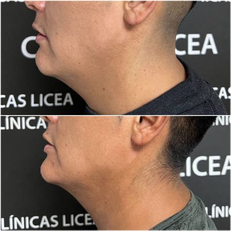 Endolaser Papada Antes E Depois - Laser endolifting papada en Zaragoza - Clínicas Licea