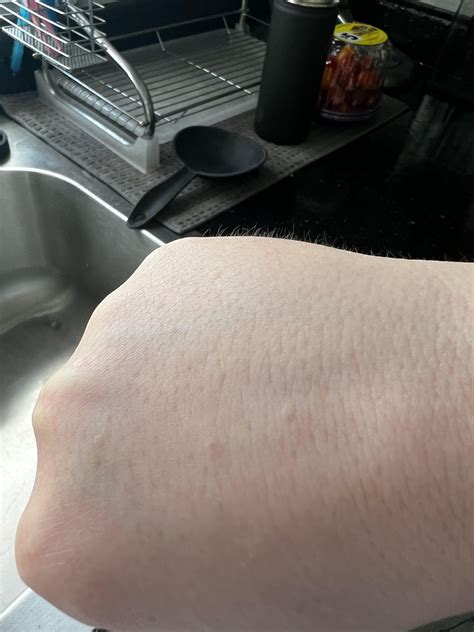 New bumps on skin : r/DermatologyQuestions