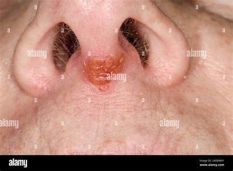 Cold sore on nose. Close-up of a cold sore on the nose of a 49-year-old ...