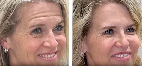 botox  south jordan ut gallery  aesthetics