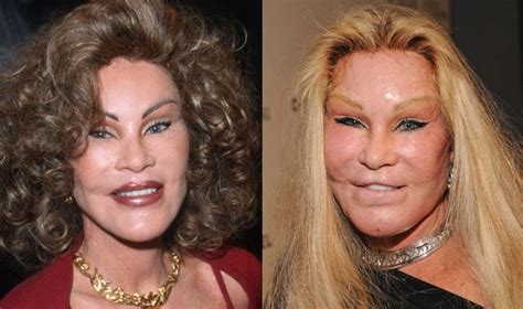 10 Worst Celebrity Plastic Surgery Mishaps | Bad celebrity plastic surgery, Celebrity plastic ...