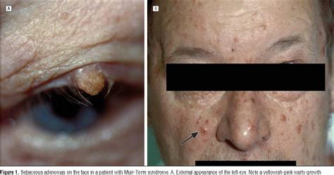 Figure 2 from Sebaceous adenoma of the eyelid in Muir-Torre syndrome ...