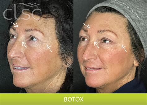 Botox in The Dalles, OR | Columbia Laser Skin Center