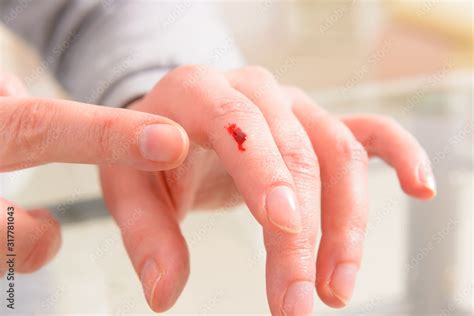 Bleeding finger, hand with a wound Stock Photo | Adobe Stock