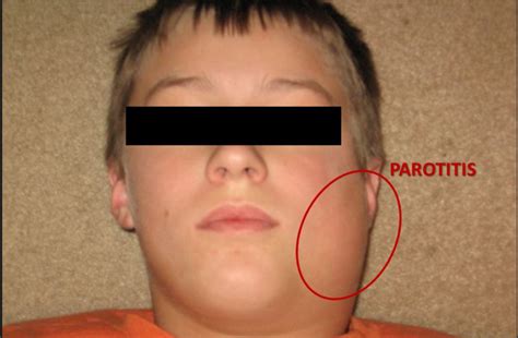 Facial Swelling As It Relates To TMJ Issues