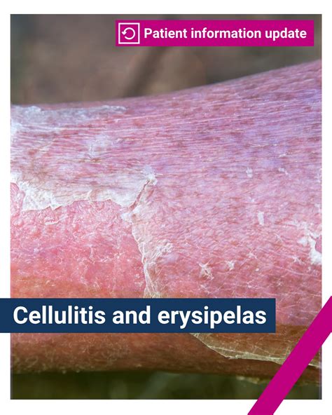 BMJ - Cellulitis and erysipelas are bacterial skin infections that