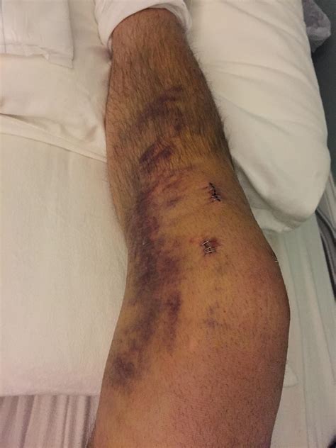 Lots of bruising. Normal? : r/ACL