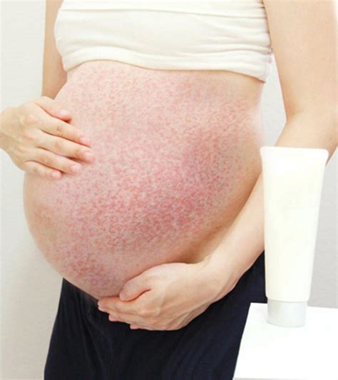 Pregnancy Bumps On Skin - Puppp Rash In Pregnancy Prevention Treatment And Remedies / Itching ...