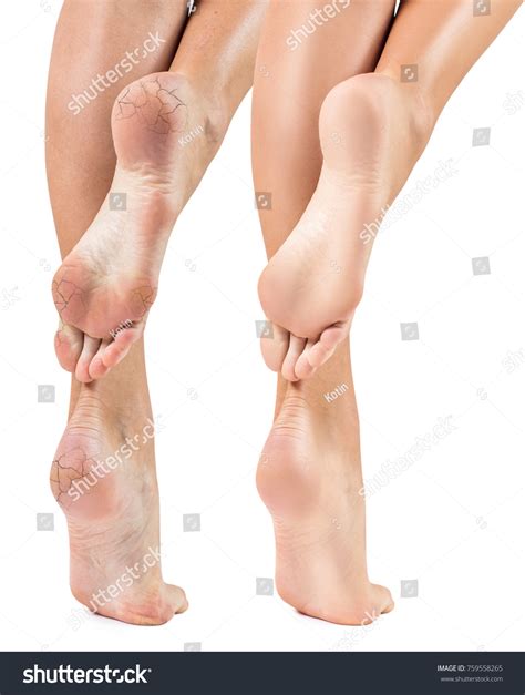 Feet Dry Skin Before After Treatment Stock Photo 759558265 | Shutterstock