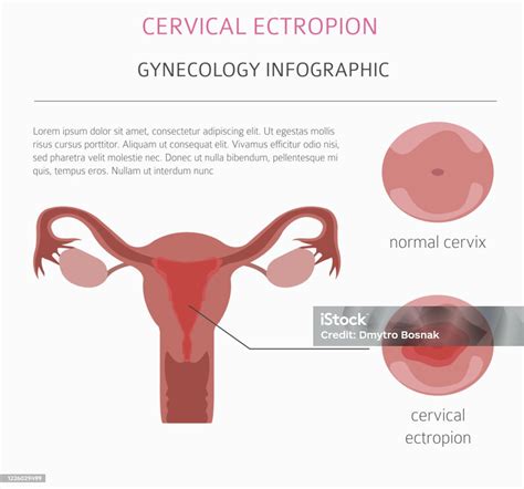 Cervical Ectropion Ginecological Medical Desease Infographic Stock ...