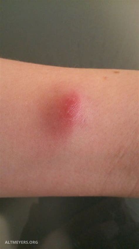 Borrelial Lymphocytoma On Cheek