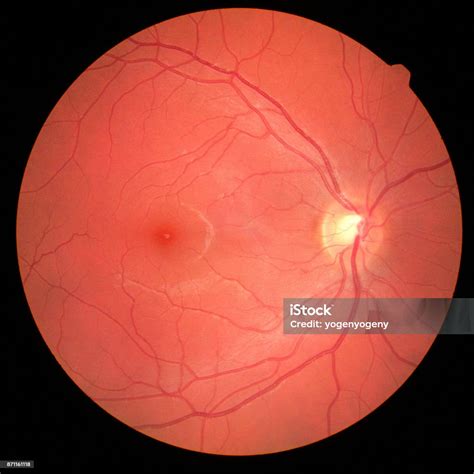 Gambar Retina Mata Kiri Dengan Macula Pembuluh Dan Iso Cakram Optik ...
