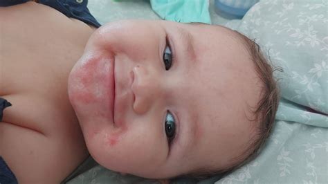 Vermelhidão E Ressecamento Ao Redor Da Boca - Vermelhidão ao redor da boca do bebê!!! | BabyCenter