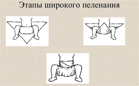 Широкое пеленание при дисплазии тазобедренных суставов у новорожденных ...