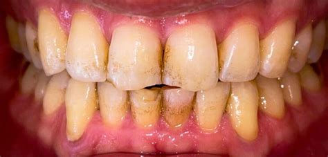 Uncover the Causes: Types of Teeth Stains Explained