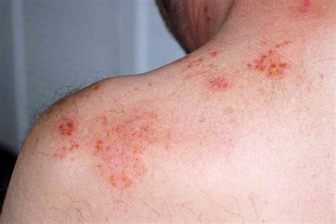 Why Do I Have a Rash on My Neck?