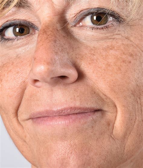 aging skin lesions