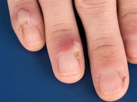 Panaritium (fijt)