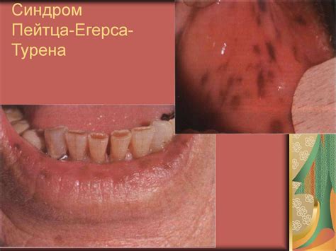 Нарушения пигментации кожи (дисхромии) - online presentation