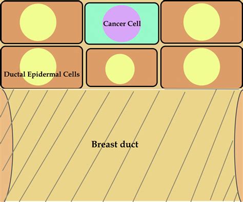 Ductal carcinoma in situ (stage-0) of the breast [6]. | Download ...