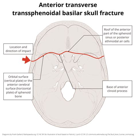 Image | Radiopaedia.org