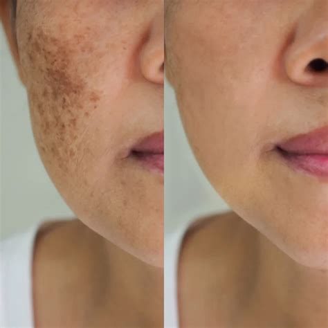 Pico Laser Before and After 1 Treatment - with images