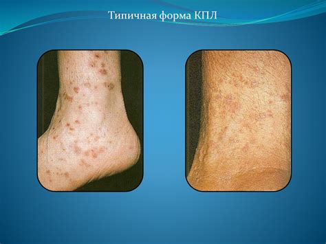 5_Лекция_псориаз,_красный_плоский_лишай - презентация онлайн