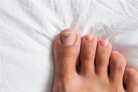 toenail fungus treatment podiatrist foot doctor allentown easton