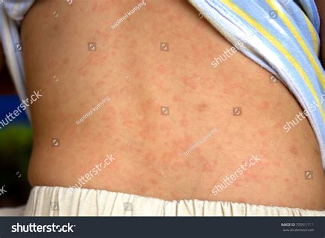 Babies Dermatitis Problem Rash Allergy Suffer Stock Photo 705511711 ...