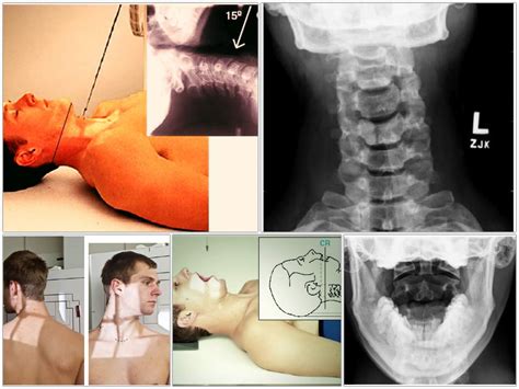 Cervical Spine or Neck X-ray Radiography - RadTechOnDuty