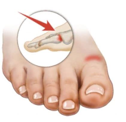 considered  big toe aspire physio glenelg