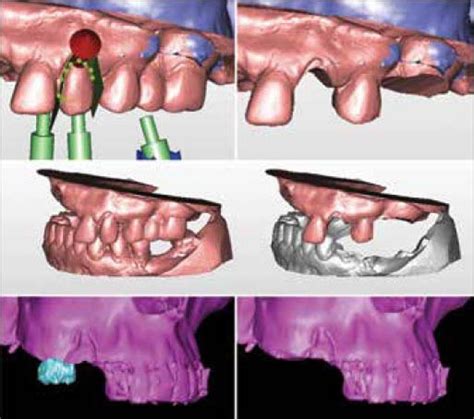 preparation  conducting computed tomography extraction